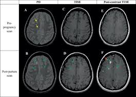 In this article, we'll go over causes, types of ms, symptoms, medications, and more. Quantitative Mri Analysis Of Cerebral Lesions And Atrophy In Post Partum Patients With Multiple Sclerosis Journal Of The Neurological Sciences