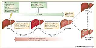 This fibrosis affects the structure and blood flow through the liver, which causes increased resistance. Schematic Representation Of Course Of Chronic Liver Diseases Etiology Download Scientific Diagram