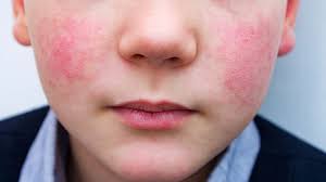 Image result for red rash face