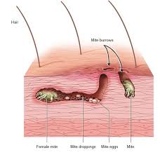 Image result for scabies on human skin