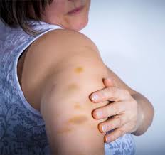 Insulin Enjeksiyonu Sonrasindaki Morarmalari Engellemek Icin 7 Oneri Diyabetimben Com