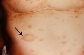 Called a herald patch, this spot can be up to 4 inches (10 centimeters) across. Pityriasis Rosea Erkrankungen Der Haut Msd Manual Profi Ausgabe