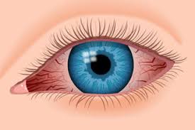 Rote augen sind keine krankheit, sondern ein symptom, das auf eine vielzahl von. Rotes Auge Was Sind Die Ursachen Von Roten Augen