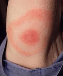 Jun 29, 2021 · » comme près de 67 000 français en 2018, florence a contracté la maladie de lyme il y a un an. Pour Les Professionnels De La Sante Maladie De Lyme Canada Ca