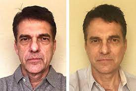 Jerry kennard, phd, is a psychologist and associate fellow of the british psychological society. Plastic Surgery For Men Male Plastic Surgery New York