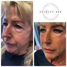 . , Celebration in order 🎉, 7 𝐦𝐨𝐧𝐭𝐡𝐬 𝐥𝐚𝐭𝐞𝐫...., (The results  were already instant however this is proof of lasting products & improved  cell renewal), -𝐋𝐎𝐖𝐄𝐑 𝐋𝐈𝐅𝐓 𝐀𝐓 𝐓𝐇𝐄 𝐉𝐎𝐔𝐋 & 𝐒𝐊𝐈𝐍  𝐓𝐈𝐆𝐇𝐓𝐄𝐍𝐈𝐍𝐆 𝑎𝑓𝑡𝑒𝑟 𝑎 ...