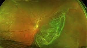 This is a much wider image than is obtainable with traditional retinal viewing methods. Rhegmatogenous Retinal Detachment Widefield Optos Retina Image Bank