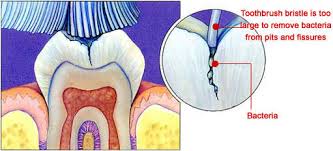 We did not find results for: Learn About Dental Sealants From A Cosmetic Dentist In Apex