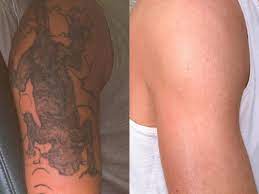 It begins with breaking up the pigments associated with your tattoo. Laser Tattoo Removal Salt Lake City Utah Gateway Aesthetic Institute Laser Center
