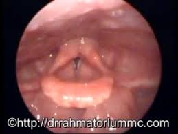 Image result for Reflux Laryngitis
