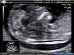 Für eine nackenfaltenmessung ist ein hochauflösendes ultraschallgerät notwendig. Erst Trimester Screening Frauenarzt In Gummersbach Steffen Maus