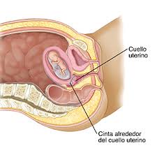 El Embarazo Y El Parto Cerclaje Cervical Transabdominal