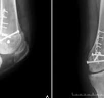 Aloenxerto osteocondral fresco do côndilo femoral posterior ...