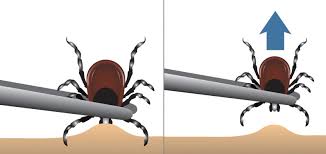 Image result for Tick Removal