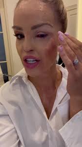 1st day back after emergency surgery 🤕 #work #disability #disabled  #disabilitytiktok #disabilityawareness #disabledtiktok #operation #surgery  #surgeon #eye #eyes #eyesight #blind #blindness ...