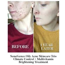 what products help with acne scarring and active acne?