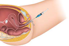 Clomid (clomiphene) is used to stimulate ovulation when the ovaries can produce a follicle but hormonal stimulation is deficient. Intrauterine Insemination Iui Obstetrics Gynecology Of Atlanta
