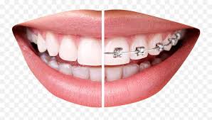 In many cases, that simply isn't true. Download Free Png Teeth With Braces Tooth Braces Png Braces Png Free Transparent Png Images Pngaaa Com