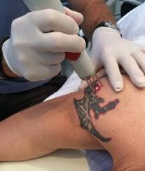 It's a common belief that tattoo : Does Laser Tattoo Removal Hurt Understanding Tattoo Removal Pain