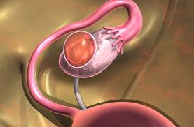 Signs of ovarian cancer are also sometimes common experiences of midlife, and mistakenly attributed to other things; Signs You Have An Ovarian Cyst And What To Do About It Health Essentials From Cleveland Clinic