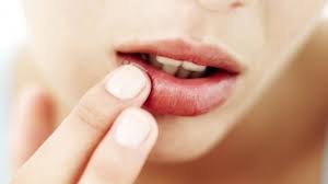 In jedem stadium der erkrankung besteht infektionsgefahr, bis der lippenherpes komplett eingetrocknet ist. Einmal Herpes Immer Herpes Onmeda De