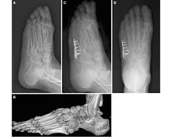 We go over the best jones fracture foot 4) base of 5th metatarsal fracture: A 64 Year Old Woman With A Fifth Metatarsal Base Fracture A Download Scientific Diagram