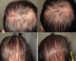 Il trattamento con letrozolo può causare la caduta dei capelli, che possono diradarsi o cadere completamente. Ormoni E Caduta Dei Capelli Quale Correlazione Poliambulatorio Medico Chirurgico Filippini