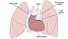 The transplanted lung is placed into the chest and attached to the bronchial tree and the pulmonary artery and veins. Heart Transplantation Wikipedia