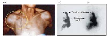 Image result for Multinodular Goiter