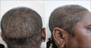 The key to treatment is identifying the underlying cause of your hair loss. Alopecia As The First Manifestation Of Azathioprine Myelosuppression In A Genetically Predisposed Patient Mishra D Sharma Sk Sharma A Jain S Dhir V Indian J Rheumatol