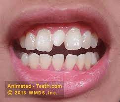 Maybe you would like to learn more about one of these? Mesiodens Supernumerary Teeth Problems Treatment Pictures