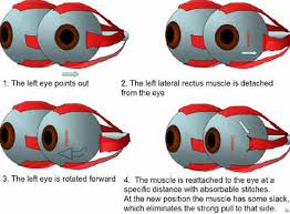 Strabismus Lazy Eye Surgery Washington Dc Maryland Virginia Pediatric Ophthalmology