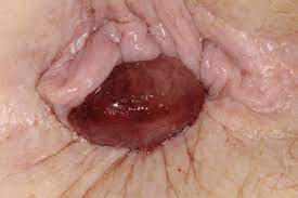 The nerves in the lower part can transmit pain messages, while the nerves in the upper part can't. The Basics Management Of Haemorrhoids Gponline