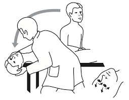 Dix hallpike test posterior bppv. Yrsel Lakemedelsboken
