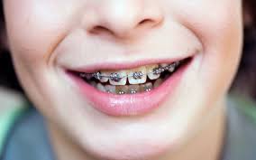 Yes, there're some ways to get orthodontic treatment (for you or your children) and don't declare for instance, there are many brands of clear orthodontic aligners that you can order right online. Do Braces Hurt What To Expect When You Get Braces
