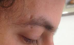 Jun 19, 2019 · use scar ointments and treatments if you have hypertrophic scarring, silicone gel and other scar treatments can be used in order to reduce its appearance. I Need To Remove A Scar Due To Eyebrow Piercing Would Excision Or Co2 Be A Better Option Photo
