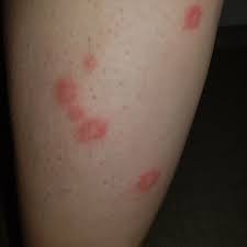 Image result for bedbugs bites
