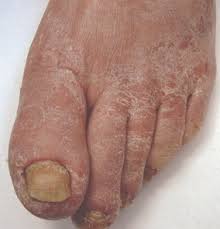 Image result for Onycholysis feet