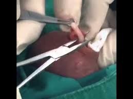 Enfoque con o sin bisturí para la vasectomía. Vasectomia Sin Bisturi Youtube