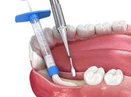 When is Bone Grafting Needed? | Robert J. Freitas II, DDS PC | Brentwood, CA