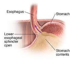 Image result for Pediatric Reflux