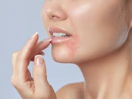 Ces glandes sont situées au fond de la candida albicans acné de la bouche peut également être le résultat d'une infection fongique. Dermatite Peri Orale Causes Solutions Remedes Point Sur L Evolution De Ma Plaque Kleo Beaute