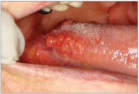 Jul 30, 2020 · transient lingual papillitis can present with mild tenderness to severe pain. Jordi Journal Of Oral Diagnosis