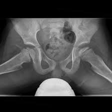 } type ii (dense deposit disease, ddd). Perthes Disease Radiology Reference Article Radiopaedia Org