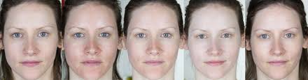 Maybe you would like to learn more about one of these? Halo Hybrid Fractional Laser 2 Month Results Styling My Life