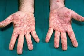 Image result for Erythema Multiforme Major