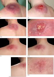 Image result for Pyoderma Gangrenosum