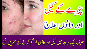 Special gharelu totkay article for women, read khoobsorti k liye ghareelo nuskhey and dozens of other articles for women in urdu to change the way they live life. Chehre Ke Dano Ka Ilaj Pimples Se Pora Chutkara How To Remove Pimples Fast Youtube