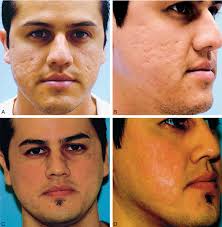 A) Preoperative patient, age 28, SPT-IV, with ice-pick and box acne...