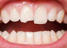 Avoiding foods that are hard to chew, such as ice and. Cracked Tooth Dental Treatments Abroad Dental Clinic Heraklion Crete Uncategorized